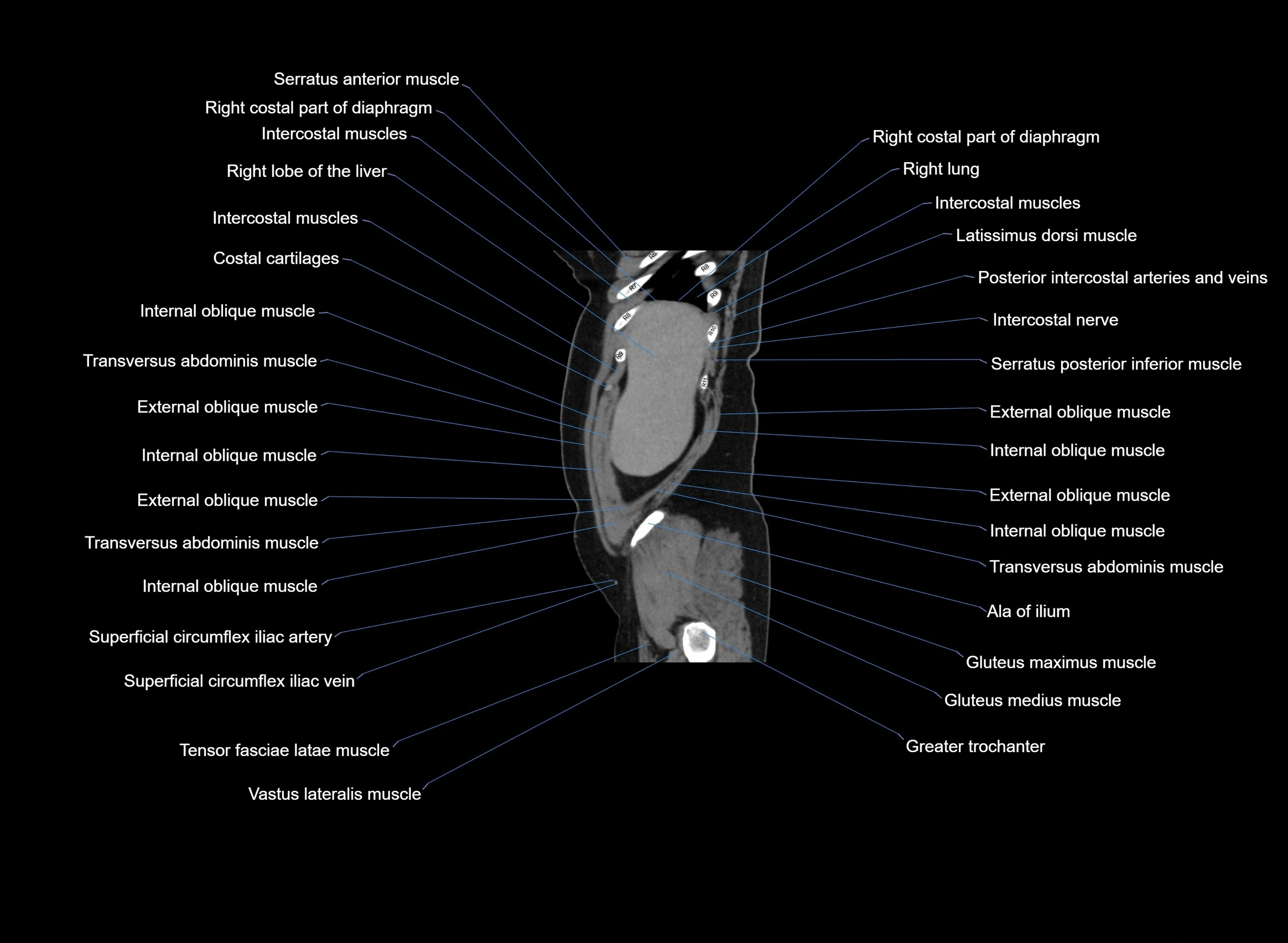 CT Abdomen sagittal cross sectional anatomy labelled radiology image -00100.webp